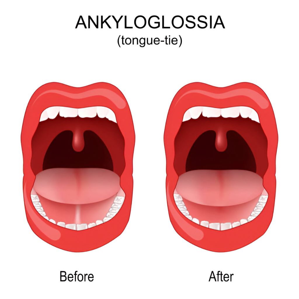 frenectomy marietta