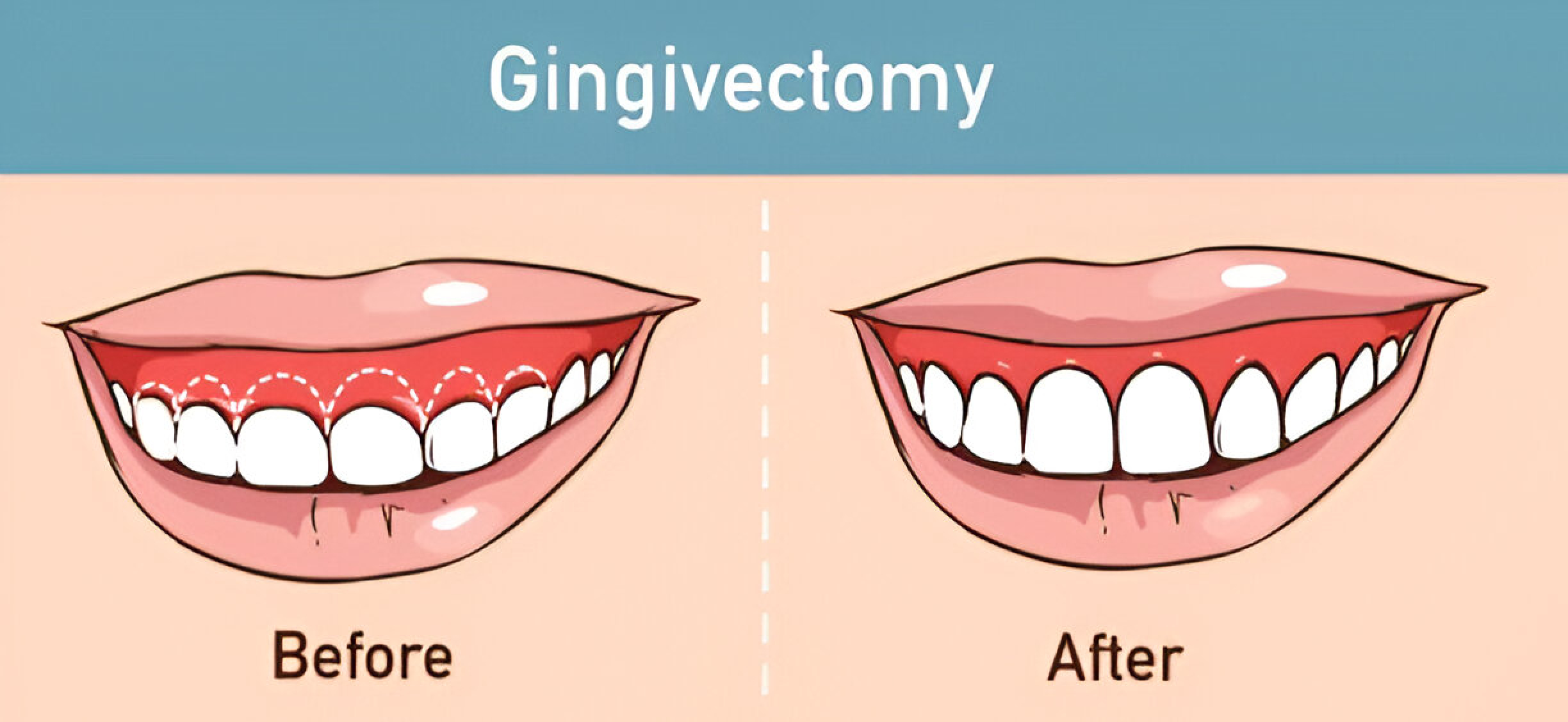 gingivectomy marietta