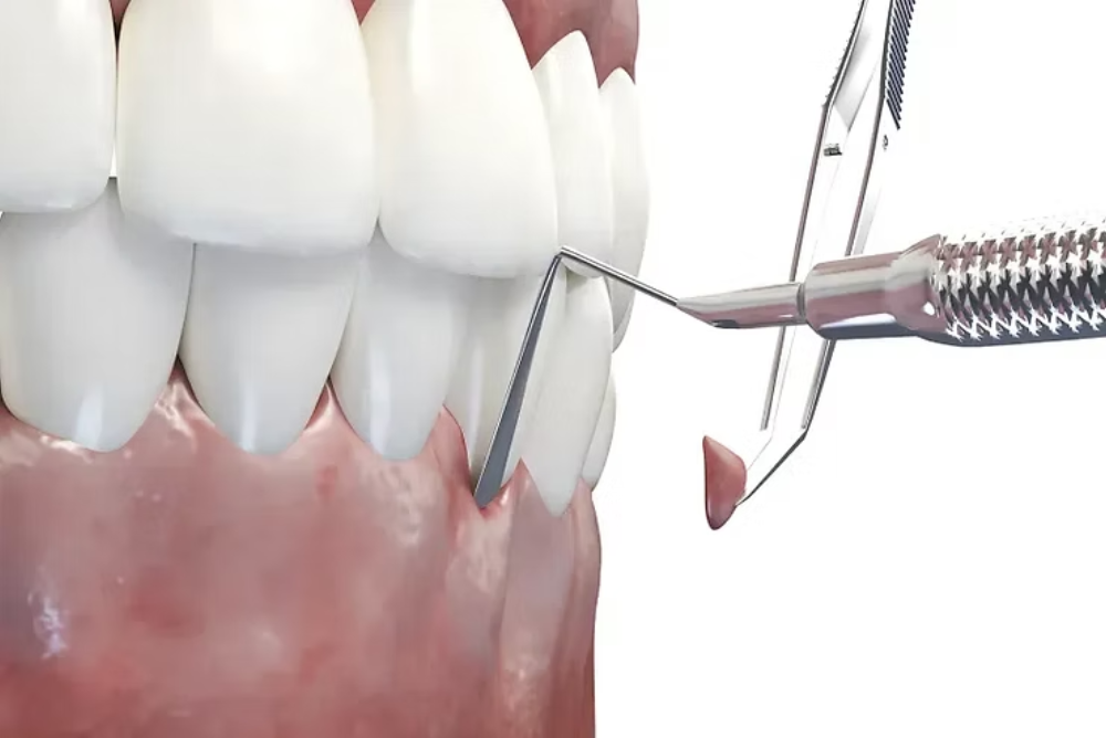 Restore your smile with expert gum grafting in Marietta. Protect roots, improve gum health, and enhance your smile with advanced periodontal care.