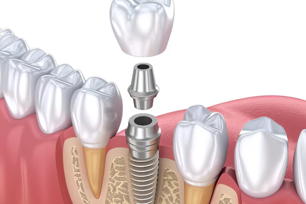Looking for dental implants near you? Kennestone Periodontics in Marietta offers advanced dental implants to restore confidence and comfort. Schedule your consultation now!