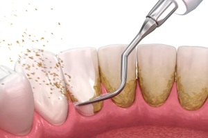 5-key-benefits-of-scaling-and-root-planing-for-your-oral-health