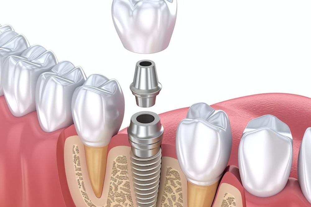 Dental Implants