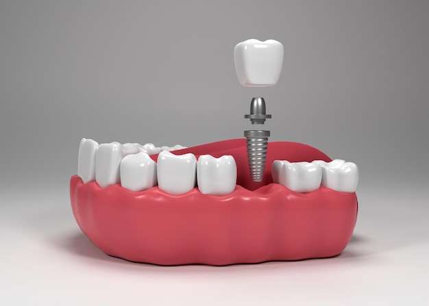 how dental implants prevent bone loss